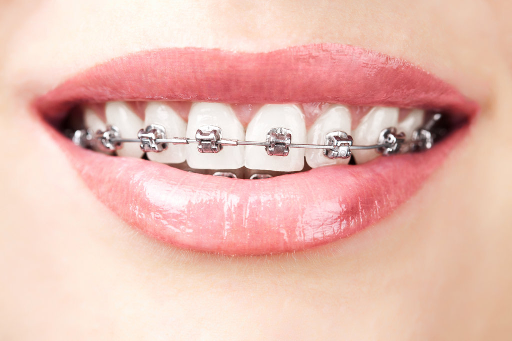 Unravelling the Connection Between Braces and Speech Clarity