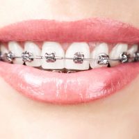 Unravelling the Connection Between Braces and Speech Clarity