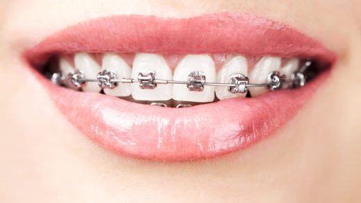Unravelling the Connection Between Braces and Speech Clarity